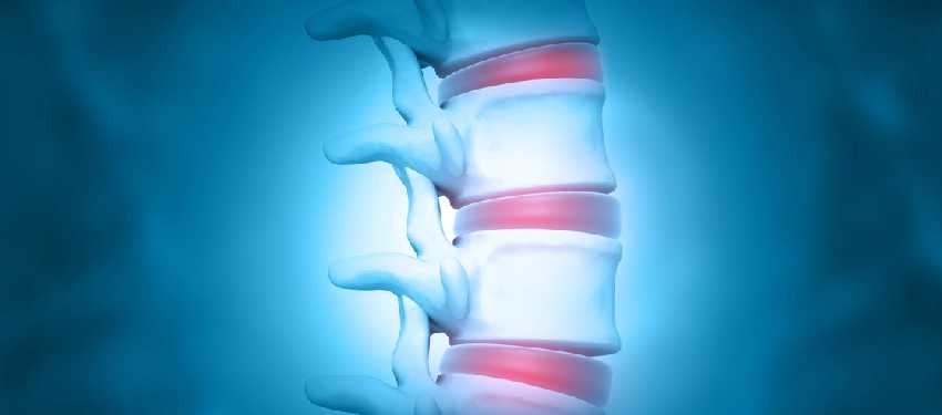 Bulging Disc