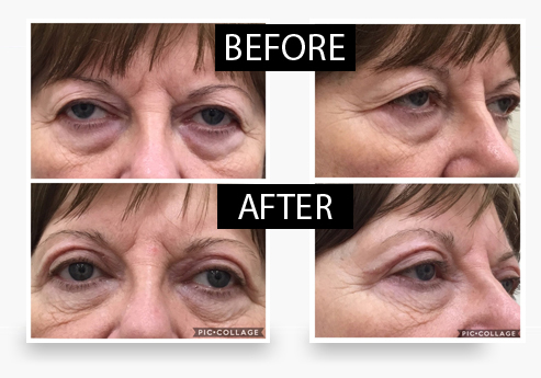 Eyelid-Lift-banner5
