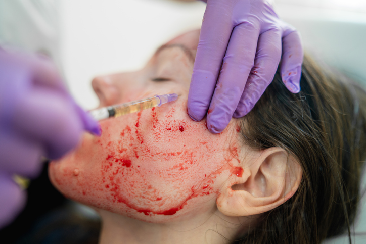 Revolutionary treatment of rejuvenation with blood plasma