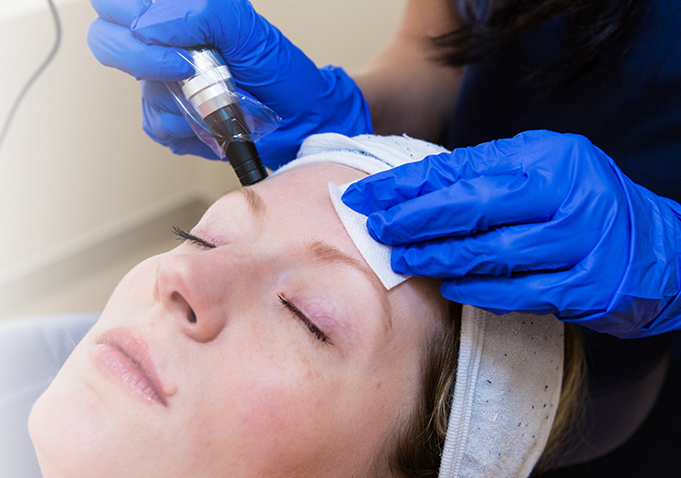 microneedling