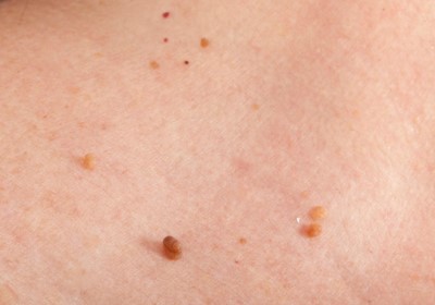 skintag
