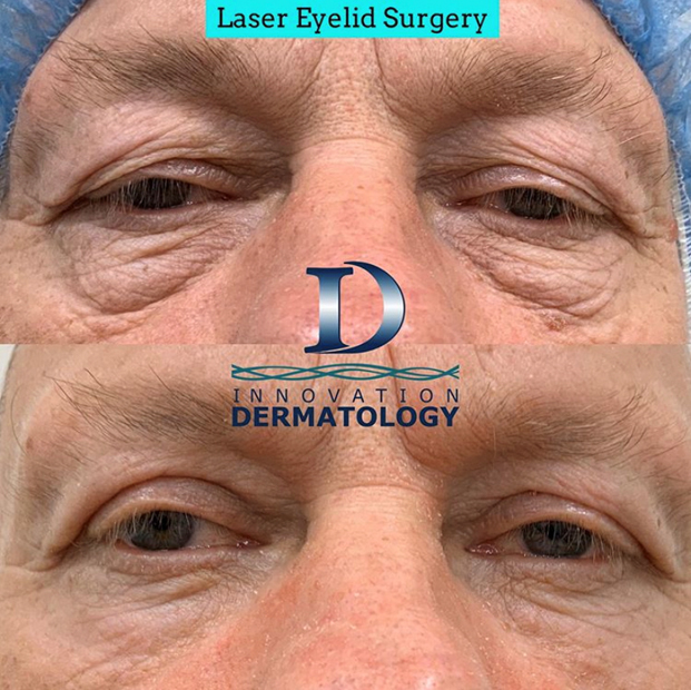 Eyelid Lift Surgery- Blepharoplasty Eyelid Lift Surgery- Blepharoplasty