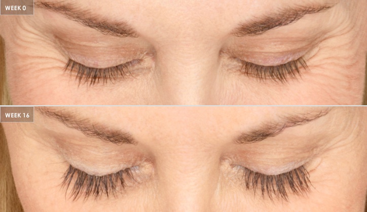 Before-After-Latisse-1