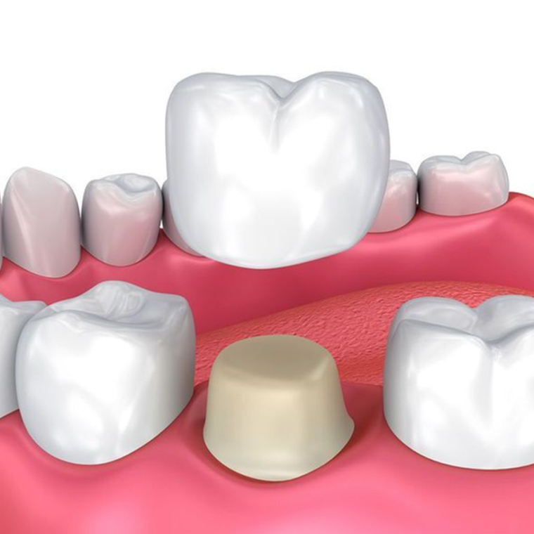 DENTAL_CROWNS