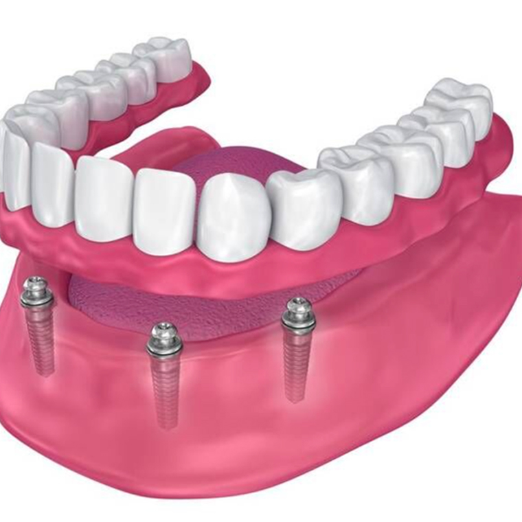 DENTURES