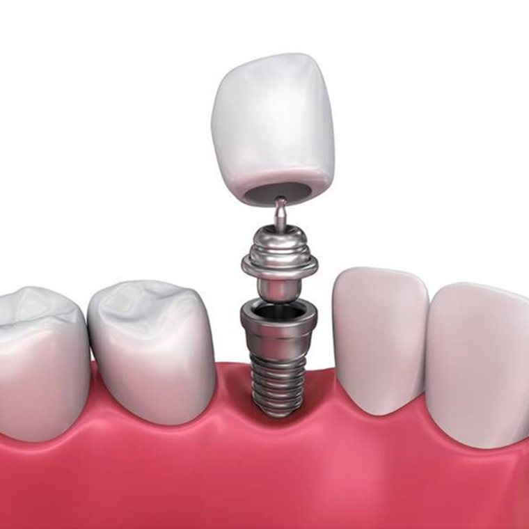 IMPLANTS