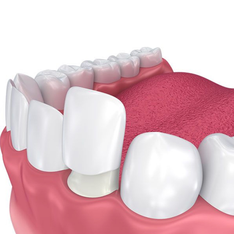 VENEERS