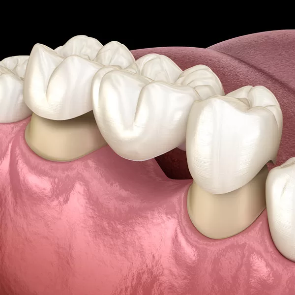 dentalbridges-sq