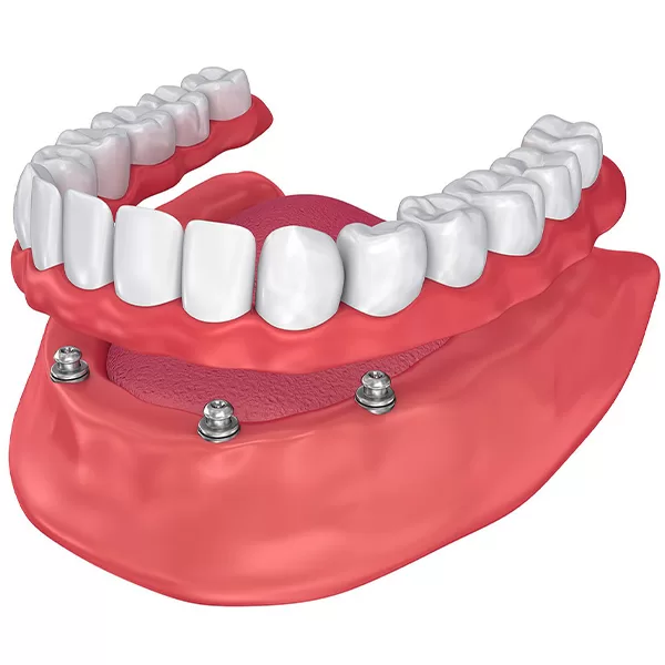 dentures-implantsupported