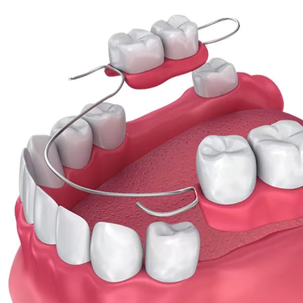 dentures-partial