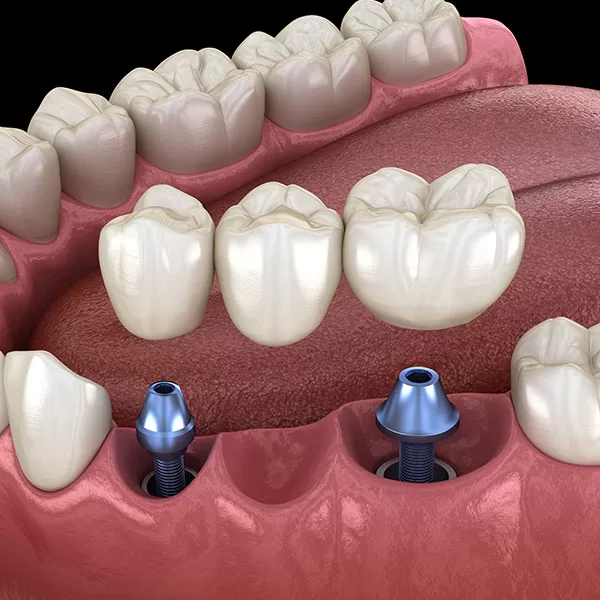 implant-bridge-Pod-600x600