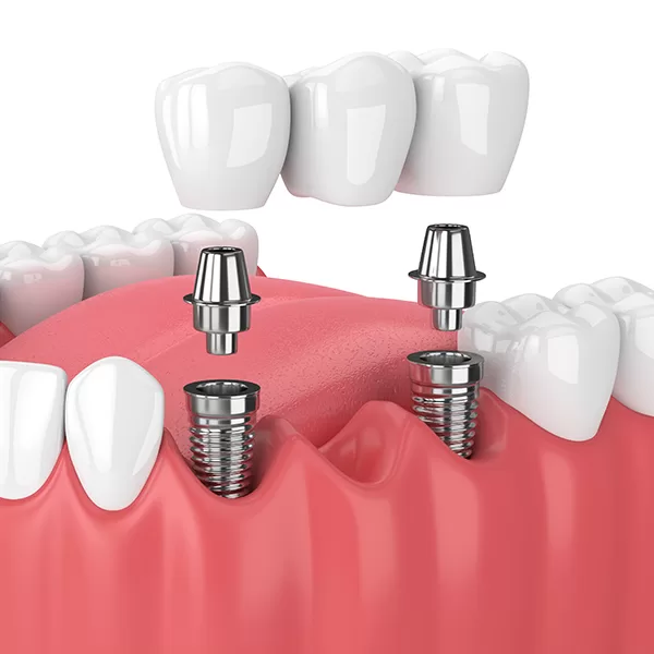 implant-bridge