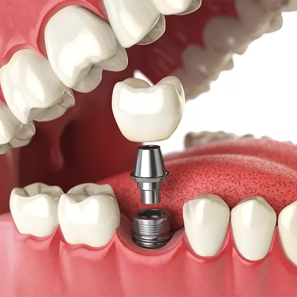 implant3