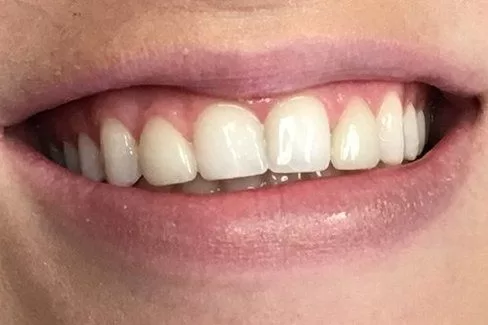 max_width_small_cosmetic-dentistry2